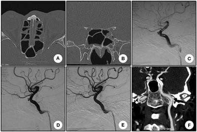 Treatment of Intracranial Pseudoaneurysms With a Novel Covered Stent: A Series of 19 Patients With Midterm Follow-Up